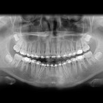 xrays of teeth