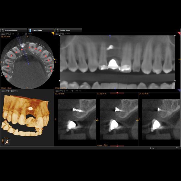 xrays of dental bridge