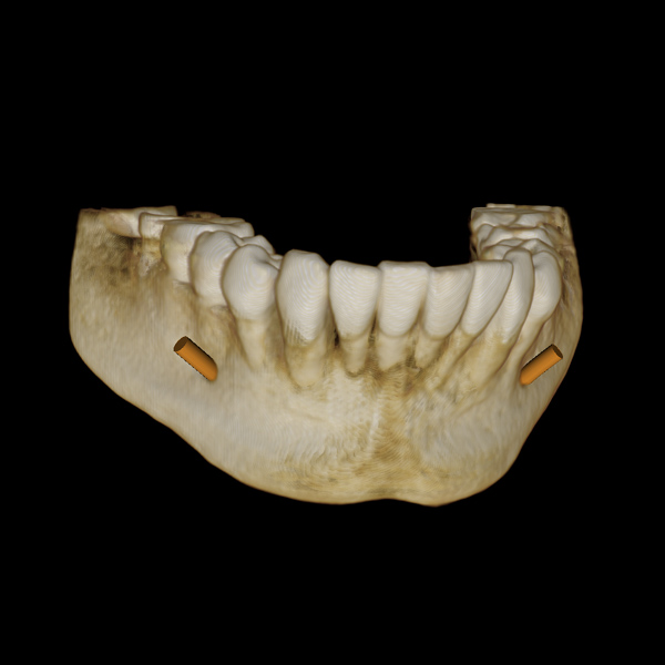 scan of lower jaw