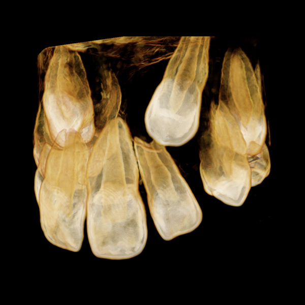 xray of crooked teeth