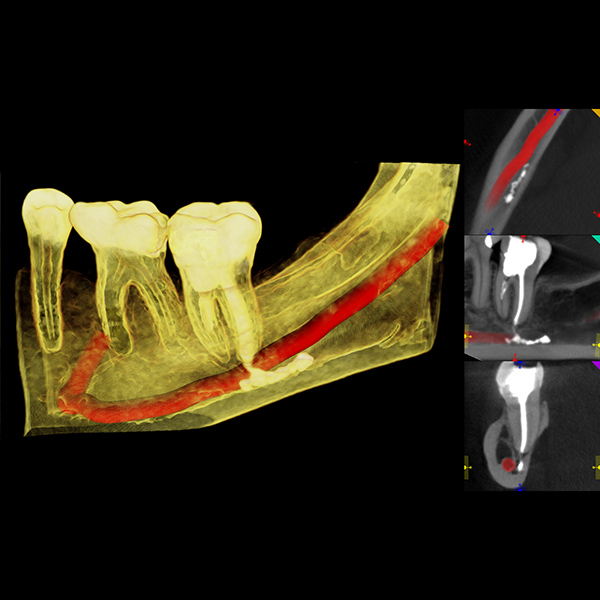 tooth and jaw xray