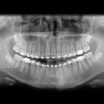 xrays of teeth