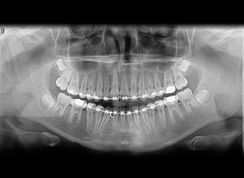 xrays of teeth